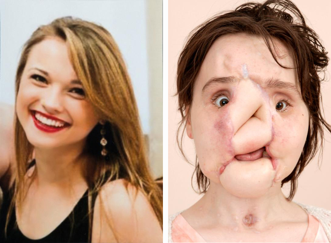 一个毁容女孩的换脸全过程,Katie Stubblefield