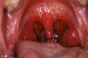 食管反流和慢性咽炎有什么关系？