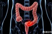 有很大治愈机会的结肠癌患者，为何会出现多发肝转移？