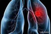 肺结节手术后对生活有什么影响？