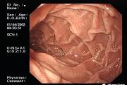 胃镜诊断为萎缩性胃炎伴糜烂，病理诊断为急慢性胃炎，哪个诊断准确？