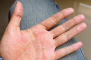 手脱皮是什么原因导致的：天气干燥导致脱皮(或皮肤病导致)