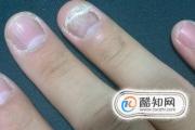 灰指甲初期症状图片