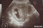 怀孕多久才能看见胎心？