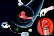 试管婴儿的胚胎移植痛苦吗？